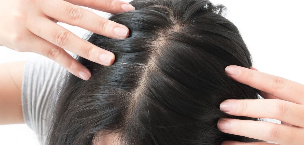 Ca&iacute;da del pelo estacoional. Qu&eacute; hacer
